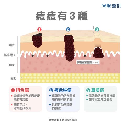 痣原因